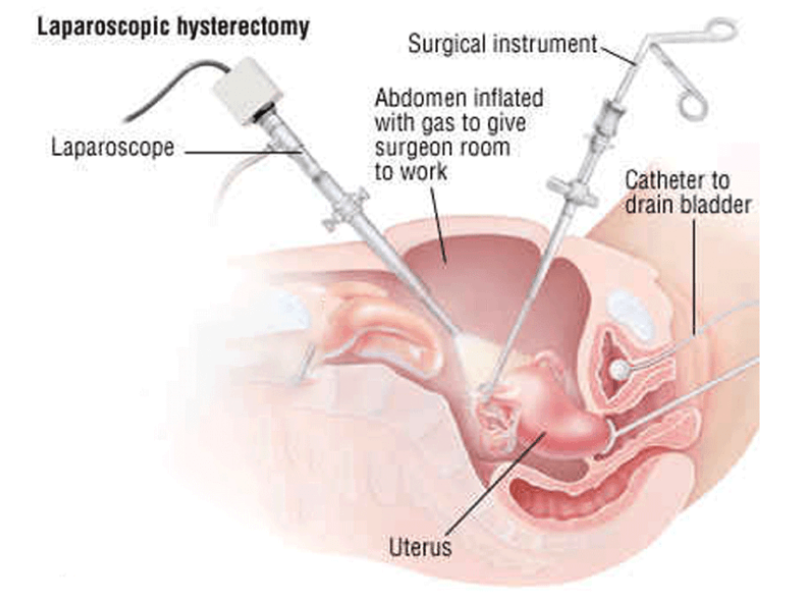 skilled doctor in our clinic provides best laparoscopic hysterectomy surgery in dubai