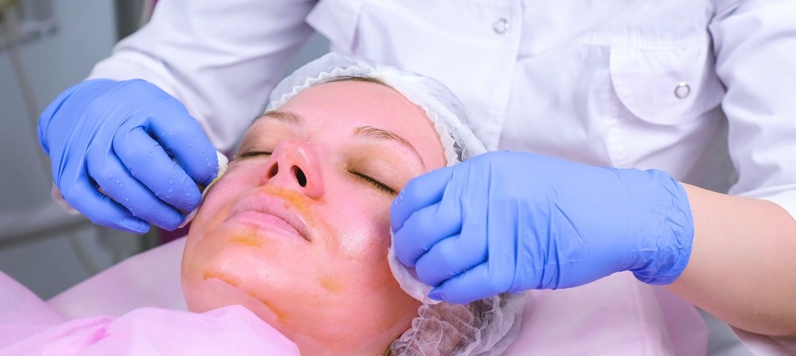 Get radiant skin with the best chemical peel in Dubai at exclusive offers