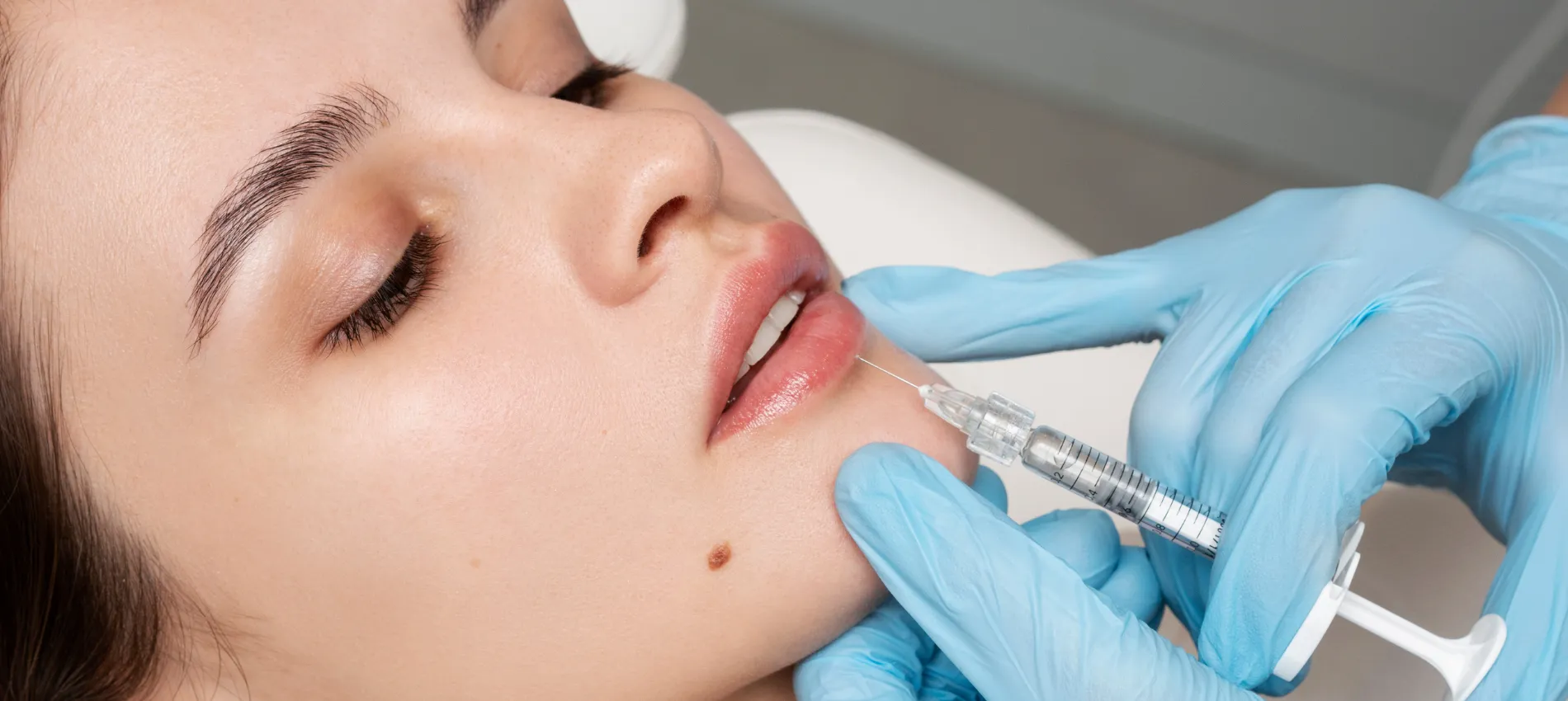 Russian lip filler in Dubai offers a lifted look. Compare Russian lip filler vs normal lip filler to choose the right style.