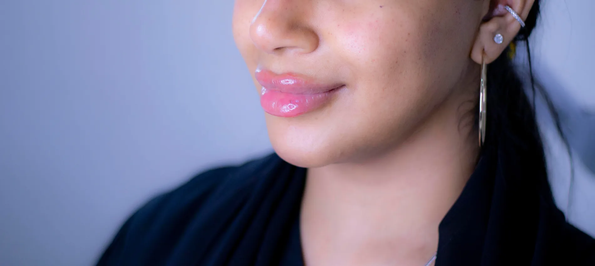 Russian lip filler in Dubai offers a lifted look. Compare Russian lip filler vs normal lip filler to choose the right style.