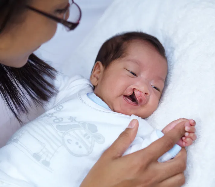 cleft lip and palate surgery in Dubai by Doctor. Ali Saleem