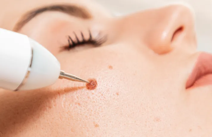 best laser birthmark removal treatment in dubai