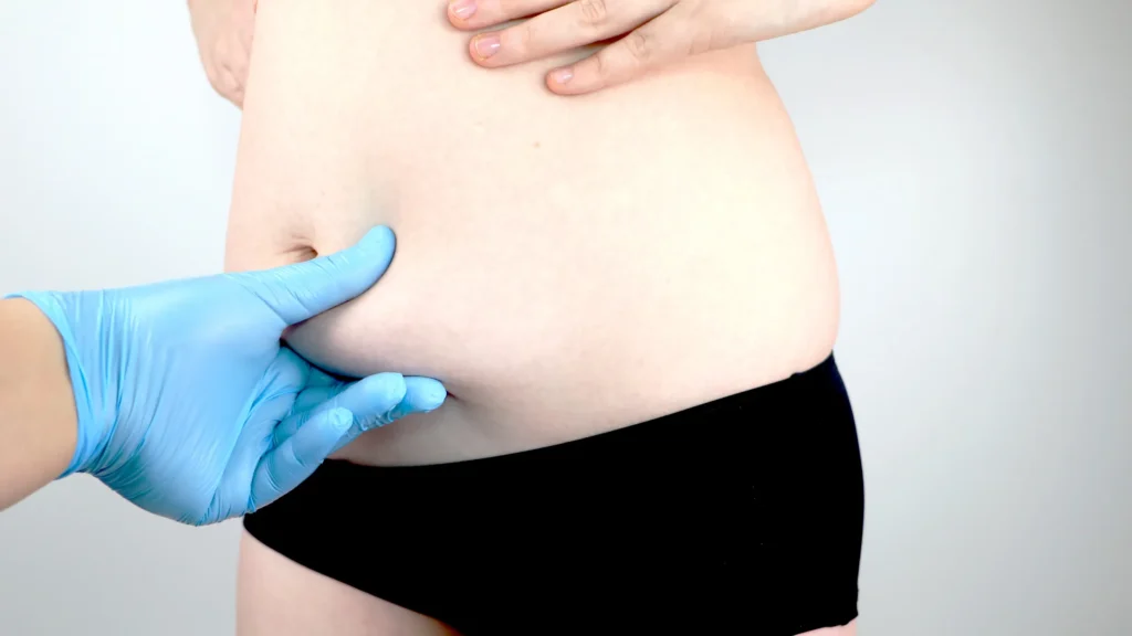 best abdominoplasty in dubai