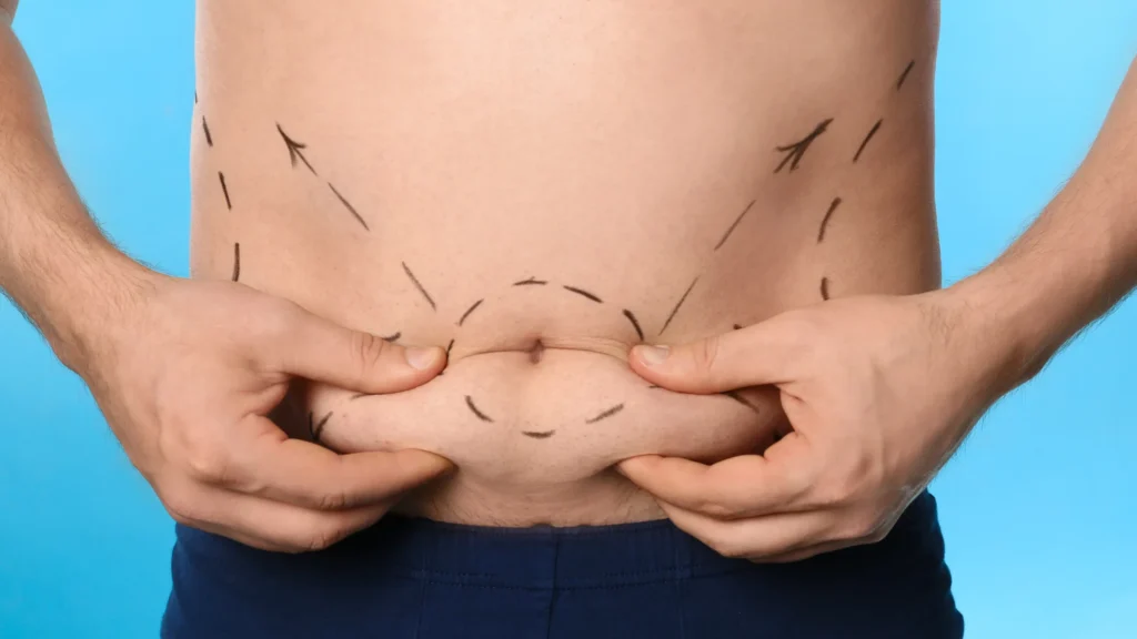 best abdominoplasty in dubai