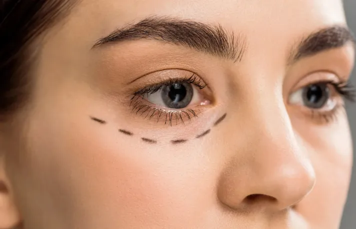 Non Surgical Blepharoplasty in Dubai