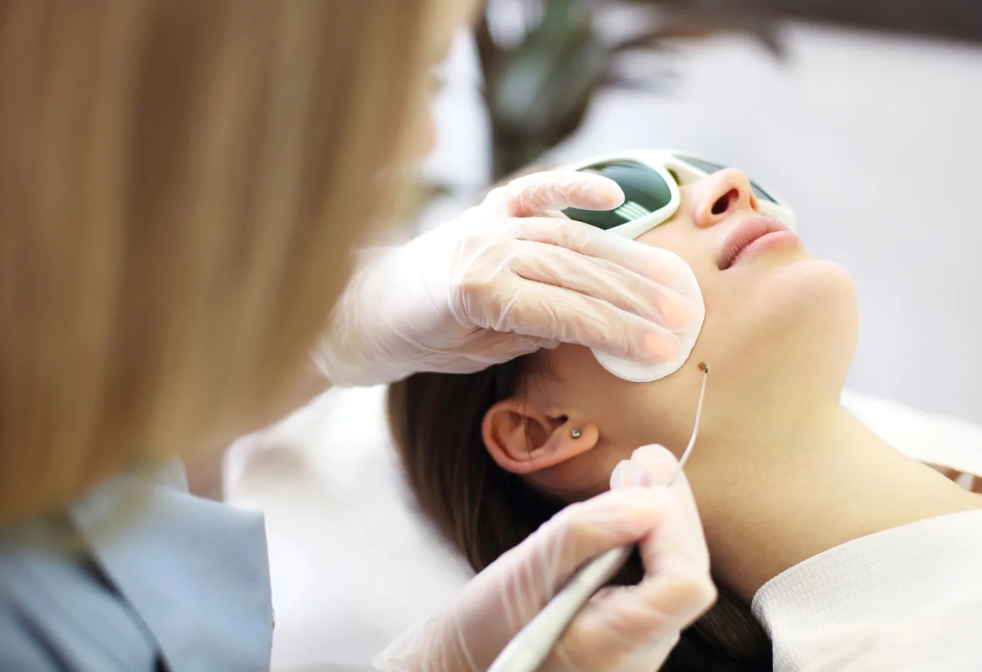 Wart removal treatment at Healia Medical Center